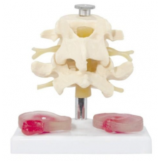 2 Lumbar Vertebrae